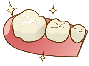 虫歯予防のシーラントって何？